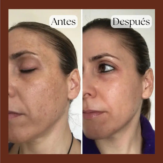 Kit Milagroso Anti-Manchas